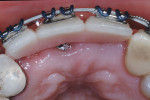 Fig 12. Occlusal view of the fixed wire temporary.