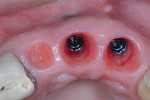 Fig 15 and Fig 16. After 3 months of tissue molding, the use of proper contours and pressure had allowed for ideal papillae and gingival margin development (Fig 15); ideal tissue thickness and health were evident (Fig 16).
