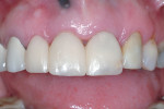 Fig 15 and Fig 16. After 3 months of tissue molding, the use of proper contours and pressure had allowed for ideal papillae and gingival margin development (Fig 15); ideal tissue thickness and health were evident (Fig 16).