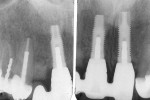 Fig 19. Radiographs 4 years post-treatment. Note the ideal crestal bone between adjacent fixtures Nos. 8 and 9 despite non-medialized platforms.
