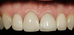 Figure 1  Disharmonies and optical differences of natural teeth and differing crown types motivated the patient to seek full-mouth rehabilitation.