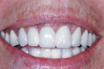 Fig 20. At the 4-year follow-up, showing the patient’s high smile, the gingival cant was significantly improved (compared to pretreatment, Fig 2), and the papillae heights had maintained ideal levels.