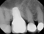 Fig 4 and Fig 5. Decay was present at margins of previous restorations on teeth adjacent to molar implants.