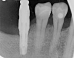 Fig 6 and Fig 7. A 4.1-mm diameter implant placed in edentulous first molar site (No. 30) adjacent to a nonrestored bicuspid (No. 29) with no previous caries, seen at the time of final prosthesis impression visit (Fig 6). At 2-year follow-up, radiograph showed caries on the approximal root surface of tooth No. 29 (Fig 7).