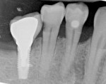 Fig 6 and Fig 7. A 4.1-mm diameter implant placed in edentulous first molar site (No. 30) adjacent to a nonrestored bicuspid (No. 29) with no previous caries, seen at the time of final prosthesis impression visit (Fig 6). At 2-year follow-up, radiograph showed caries on the approximal root surface of tooth No. 29 (Fig 7).