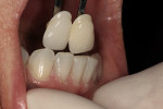 Figure 2  Shade selection against natural teeth show the patient’s desired shade.