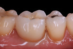 Fig 8 and Fig 9. Placement of an 8-mm diameter implant with a 6.5-mm platform immediately upon extraction of tooth No. 30 (Fig 8) resulted in excellent crown contours, minimal gingival embrasure space, and reduced ITD (Fig 9).