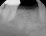 Fig 10 and Fig 11. In a single healed molar extraction site where the ridge was too narrow to place one wide implant (Fig 10) two 4.1-mm diameter implants were placed (Fig 11). The distance between the teeth at the level of the alveolar crest was 14.5 mm and the width of the ridge was 6.8 mm. Placing two narrower implants allowed the ITD to the adjacent teeth to be minimized. This case may be restored as either two bicuspids or one molar with a small cleansable embrasure between the implants.