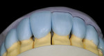 Figure 3  Wax-up of the IPS e.max crowns with silicone index and cutback.