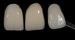 Figure 6  View of 1M1 shade tab compared to custom-made shade crowns for the patient’s verification.