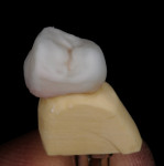 Figure 8  View of the overlay of build-up on the posterior crowns.