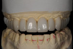 Figure 9  Final restorations on the solid model on the articulator; red marks serve as reference points, guiding what not to do.