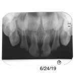Pretreatment radiograph demonstrating caries and pulpal status. Indirect pulp capping is preferable to pulpotomy when the pulp is normal or exhibits reversible pulpitis.