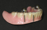 Figure 2  Lower denture with radiographic markers attached to it that will double as a surgical template.