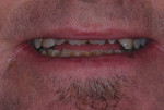 Pretreatment close-up smile photograph.