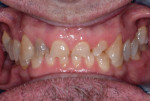 Pretreatment retracted view with teeth in
complete occlusion.