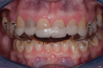 Retracted facial view of the Bioesthetic MAGO positioned in the mouth.