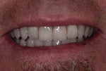Close-up smile photograph of the final glass ceramic restorations.