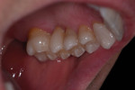 Open mouth maxillary occlusal view of the final restorations. Note how the crown margins are positioned to preserve a wide band of enamel, maximizing bond strength.