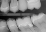 Right and left bite-wing radiographs of the final glass-ceramic restorations.