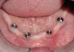 Figure 5  Implants showing keratinized attached gingiva are easier to keep healthy.