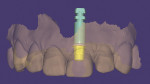 Fig 5. Virtual treatment plan imported into dental CAD/CAM software with virtual Ti base placed.