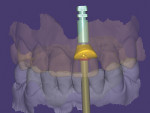 Fig 7. Customized healing abutment completed in dental CAD/CAM software.