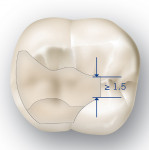 Fig 1. Occlusal view of a molar onlay demonstrating recommended fissure width. (Illustration used with permission from VOCO GmbH)