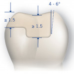 Fig 2. Lateral view of a molar onlay demonstrating recommended cuspal and pulpal reduction. The degree of divergence for insertion and draw is also illustrated. (Illustration used with permission from VOCO GmbH)