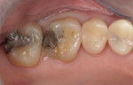 Fig 3. Preoperative occlusal view, Case 1.