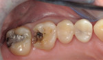 Fig 4. Alloy was removed from tooth No. 3.