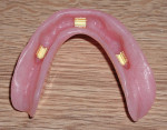 Figure 10  Clips under the overdenture in the metal housings for easy replacement.