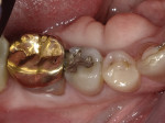 Fig 13. Preoperative occlusal view, Case 2.