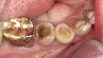 Fig 15. Occlusal view of the preparations.