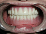 Figure 11  Mandibular bar overdenture with excellent support, retention, and comfort for the patient.