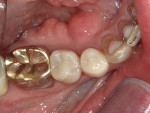Fig 16. Occlusal view of the final restorations.