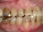 Fig 17. Buccal view of the final restorations.