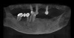Fig 2. Preoperative radiograph. The patient’s remaining teeth were Nos. 6, 8, 12, 27, 28, 29, and 31. Caries was present on teeth Nos. 6M, 8M, 12M, and 27. Tooth No. 12 had root canal treatment.