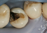 Figure 2  Recurrent decay was visible after removal of the old amalgam.
