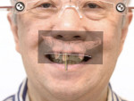 Fig 9 through Fig 11. By merging the Duchenne smile photograph, intraoral scan, and CBCT scan of the maxilla, the planning of implant placement in the maxilla was started in a facially driven approach.