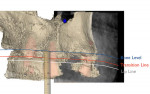 Fig 9 through Fig 11. By merging the Duchenne smile photograph, intraoral scan, and CBCT scan of the maxilla, the planning of implant placement in the maxilla was started in a facially driven approach.
