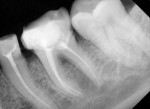 Fig 7. Radiograph immediately after obturation with gutta percha.