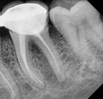 Fig 8. Radiograph after the PFM crown placement.
