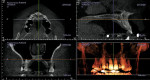 Figure 1  A 3D imaging of the maxilla: axial, sagittal, coronal, and volumetric views.