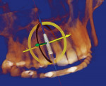 Figure 3  Interactive planning of a single implant for a missing lateral incisor.