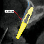 Figure 4  Cross-sectional view showing virtual implant placement and distance to the facial cortical plate.