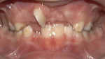 Fig 1. A 7-year-old patient with a congenitally missing maxillary left central incisor.