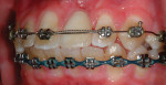Fig 4. Conclusion of initial orthodontic treatment.