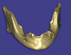 Figure 12  Final view showing treated surface of mesial of tooth A.