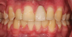Fig 6. Final orthodontic debond images revealed a noticeable reduction of incisor protrusion and proper mesial-distal distance from the teeth adjacent to the future implant.